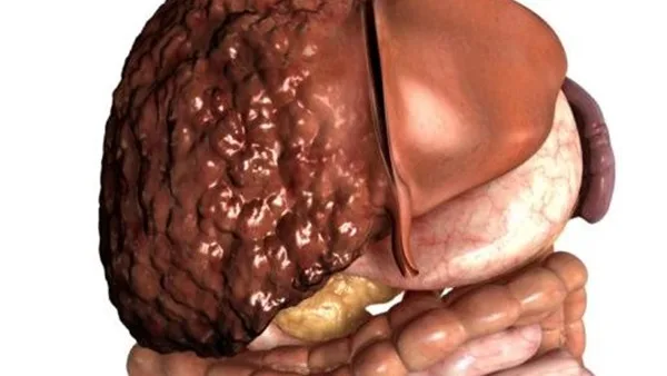The relationship between fat and sugar and the risk of liver cancer 2 464 - C J Global Newspaper