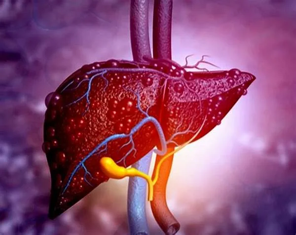 The relationship between fat and sugar and the risk of liver cancer 3 OIP457978 - C J Global Newspaper