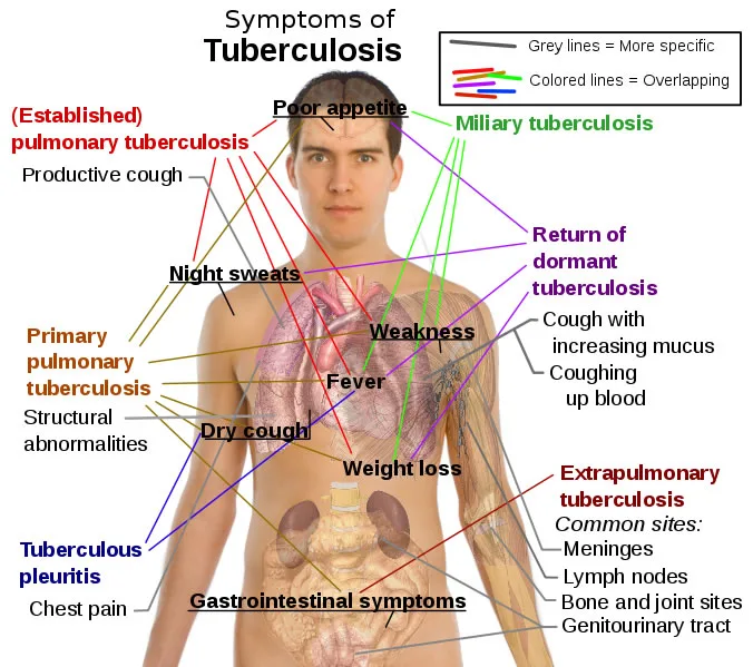 Tuberculosis revives the fears as US health reported 67 cases in Kansas since it outbreaks 1 tb - C J Global Newspaper