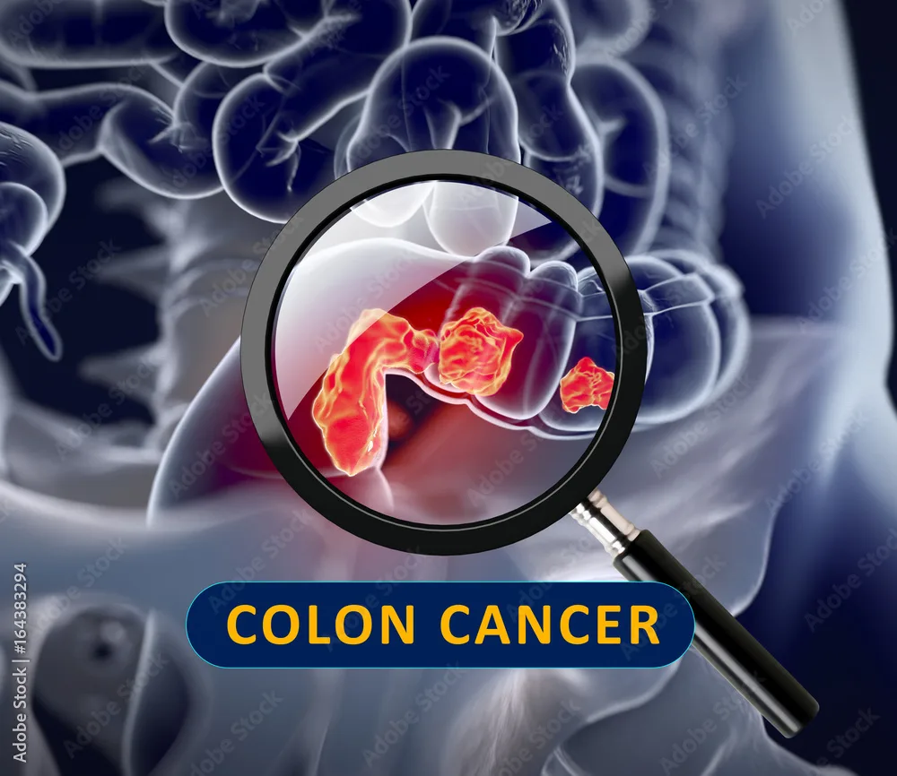 Stop these habits to reduce Colorectal Cancer Risk 1 - C J Global Newspaper