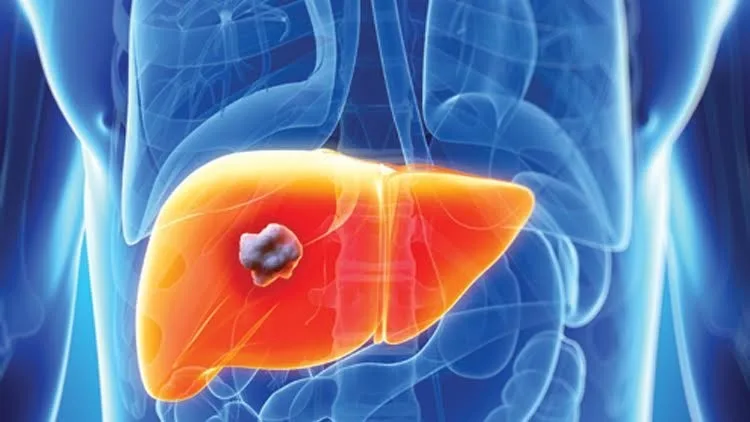 The relationship between fat and sugar and the risk of liver cancer 1 57688 - C J Global Newspaper