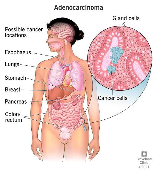 Pancreatic Cancer Risk Linked to Alcohol Consumption, Says New UN Study 1 IMG 7966 - C J Global Newspaper
