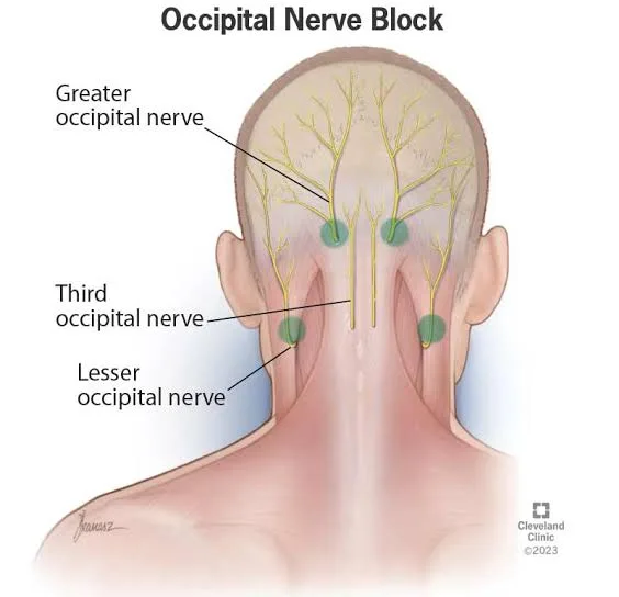 Occipital Nerve Decompression for Occipital Neuralgia: A Promising Solution 2 IMG 8183 - C J Global Newspaper