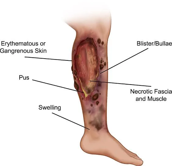 Necrotizing Fasciitis Awareness Day: Shining a Light on a Rare but Deadly Disease 1 IMG 8204 - C J Global Newspaper