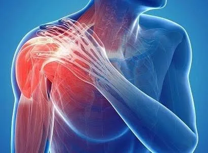 Shoulder Pain After Neck Surgery: Understanding the Causes and Finding Relief 3 IMG 8473 - C J Global Newspaper