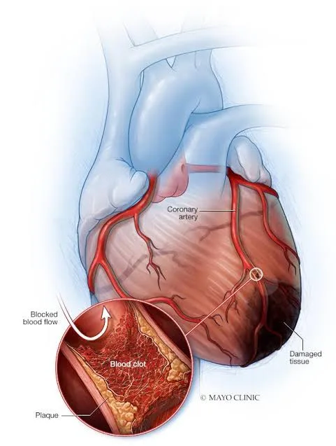 Air Pollution and Heart Disease: Study Reveals Link to Plastic Chemicals 2 IMG 8724 - C J Global Newspaper