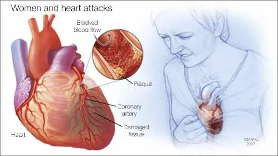 Air Pollution and Heart Disease: Study Reveals Link to Plastic Chemicals 4 IMG 8725 - C J Global Newspaper